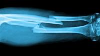 X-ray image of a broken arm.
